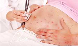 Rubella nguy hiểm với phụ nữ mang thai