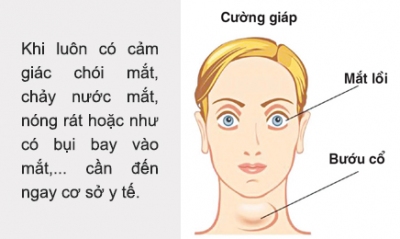 Lồi mắt trong bệnh bướu cổ cường giáp