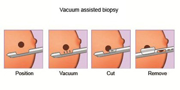 Vacuum Assisted Biopsy 420x210