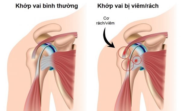 Hội chứng chóp xoay vai minhanh