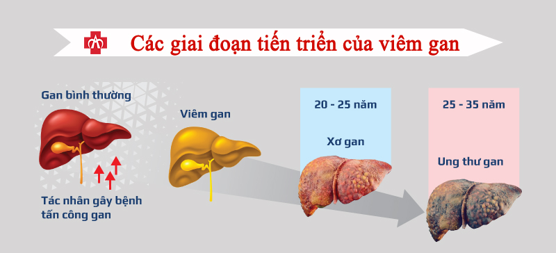 viem gan sieu vi 1