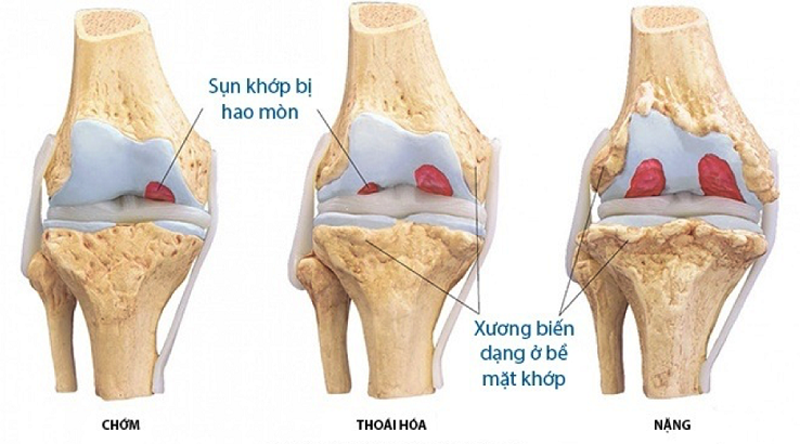 thoai hoa khop goi co chua duoc khong minhanh