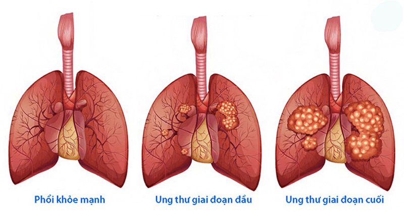 ung thu phoi minhanh 2