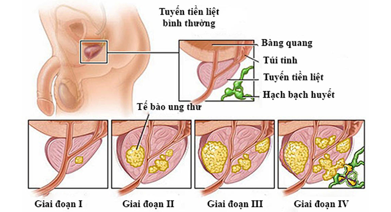 ung thu tuyen tien liet minhanh