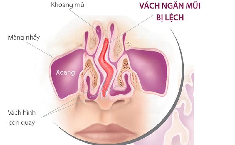 veo vach ngan minhanh 1