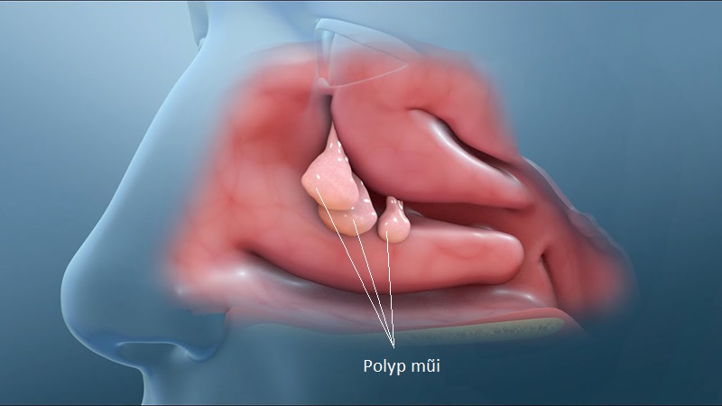 polyp mũi minhanh