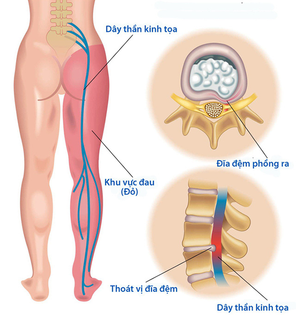 H 4 Thoát vị đĩa đệm gây nên Hội chứng đau thần kinh tọa