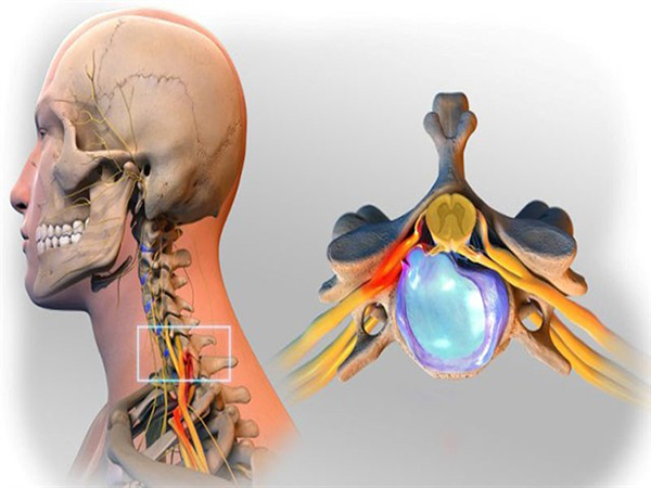 H 5 Thoát vị đĩa đệm cột sống cổ