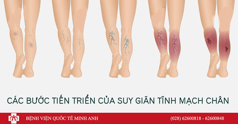 suy gian tinh mach chan minhanh